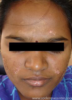 Vitiligo-treated